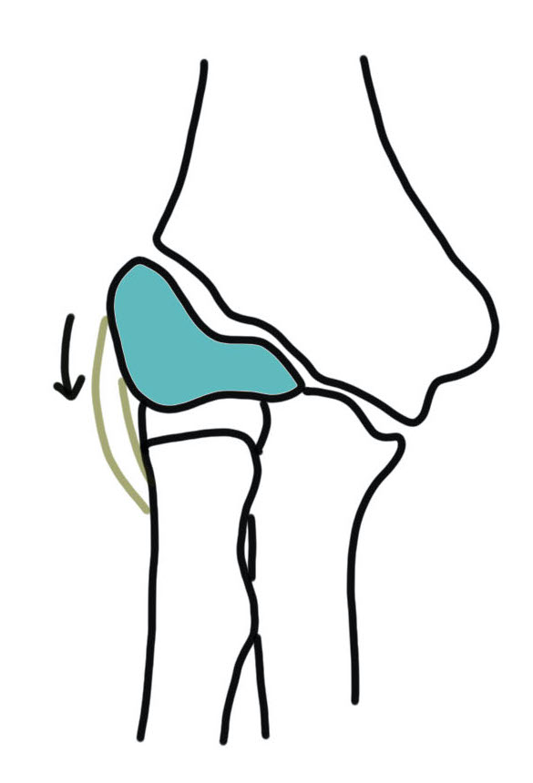 Lateral Condyle Fractures The Bone School